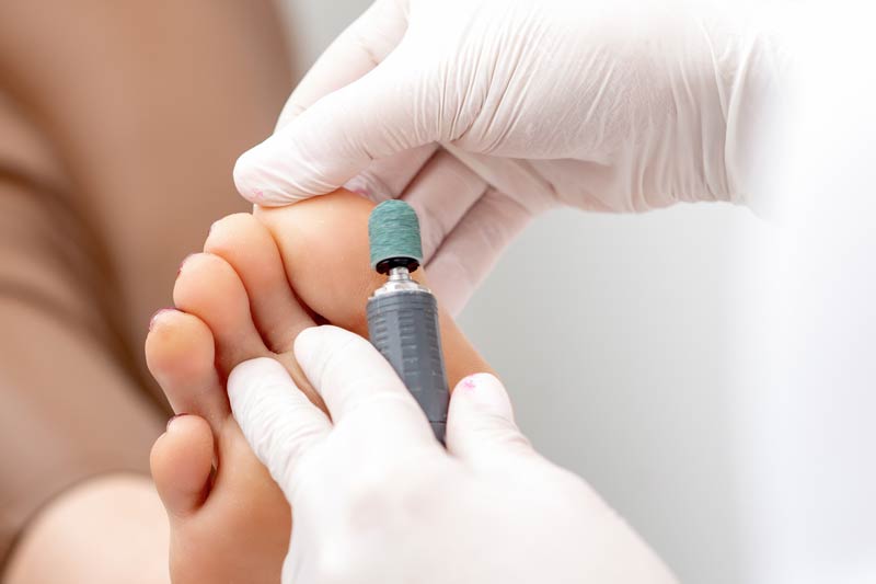 Callus treatment from a Podiatrist